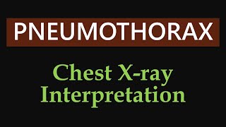 Pneumothorax amp Tension Pneumothorax  Chest Xray Interpretation [upl. by Nnylimaj]