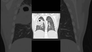 HRCT Chest Necrotizing pneumonia viralreels [upl. by Aisercal889]