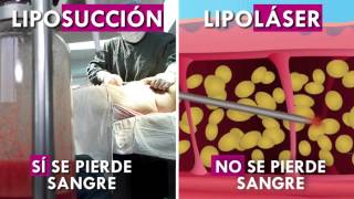 LIPOLÁSER VS LIPOSUCCIÓN [upl. by Nivk]