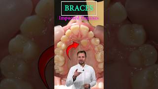 💖 HOW BRACES WORK for Impacted Canine❓ [upl. by English756]