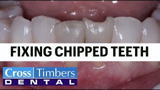 Case of the Week  Fixing chipped teeth [upl. by Aysahc]