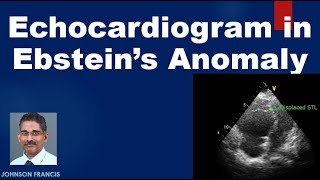 Echocardiogram in Ebsteins Anomaly of Tricuspid Valve [upl. by Odnalo533]