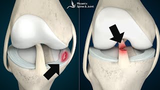 Is your knee pain coming from an ACL tear or Meniscus injury How to tell [upl. by Hedda]