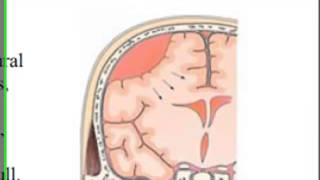 Brain Hematomas  EMS Head Injury Patients [upl. by Retep]