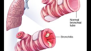 Bronchiolitis [upl. by Kathryn]