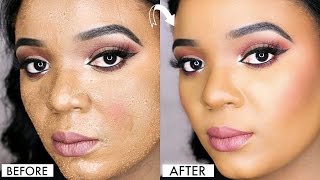 HOW TO AVOID CAKEY FOUNDATION amp SMUDGY CONCEALER ON ACNE PRONE SKIN  OMABELLETV [upl. by Britt]