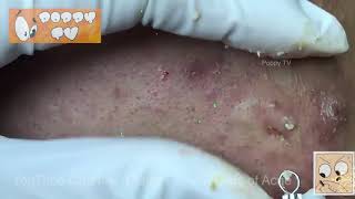 ❤️Too Many Blackheads Extraction of Large Acne❤️ [upl. by Adeuga685]