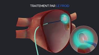 MEDUVIP  Teaser Vidéos Médicales Pédagogiques  Ablation de FA [upl. by Bud]