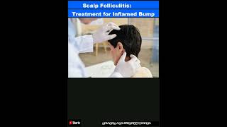 Scalp Folliculitis Treatment for Inflamed BumpsShorts [upl. by Rodolphe]