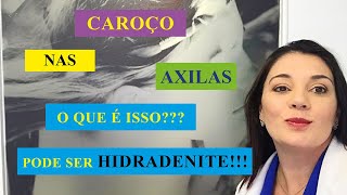 Dor e caroços nas axilas podem ser HIDRADENITE [upl. by Yentrac859]