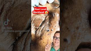 Crazy Solar Comedones Removal  BEST BLACKHEAD REMOVAL 2025 shorts [upl. by Nawuq]