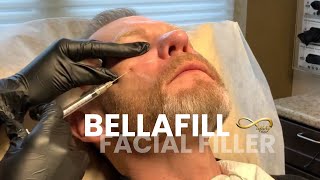 Bellafill Facial Filler  Infinity MedSpa [upl. by Sheffie468]