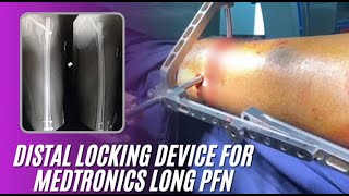 DISTAL LOCKING JIG FOR METRONICS LONG PFN LIVE DEMONSTRATION IN A CASE OF INTER TROCHANTER FRACTURE [upl. by Sikata]