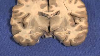 Hypothalamus Neuroanatomy Video Lab  Brain Dissections [upl. by Wilinski948]