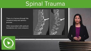 Spinal Trauma Cervical Trauma Protocol Common Spinal Fractures – Radiology  Lecturio [upl. by Lebanna]