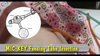 MICKEY Feeding Tube Insertion [upl. by Cinda]