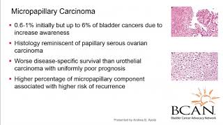 Bladder Cancer Urothelial Carcinoma [upl. by Adnoraj]