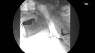 Single Contrast Esophagram Leak Study [upl. by Werdna]