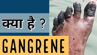 Gangrene  क्या है [upl. by Helmer578]