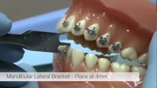 American Orthodontics Alexander LTS Brackets  Bracket Placement Video [upl. by Tabina]