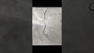 Angioplasty of SVG to PDA Graft with Embolic protection device in post CABG patient after 5 year [upl. by Inod]