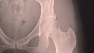 Hip Dysplasia amp Surgery [upl. by Nostets]