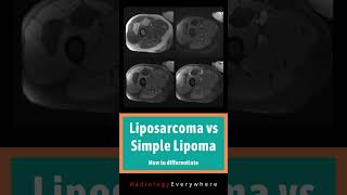 How to differentiate liposarcoma from lipoma  MSK Radiology  1000 cases in 100 days  video 41 [upl. by Eenet]