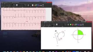 Left Anterior Fascicular Block LAFB  Left Anterior Hemiblock ECG [upl. by Enninaej]