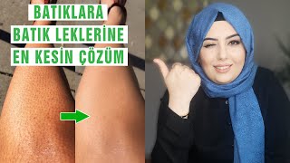 Pürüzsüz Bacaklar İçin Batıklara ve Batık Lekelerine En Kesin Çözüm [upl. by Atirabrab]