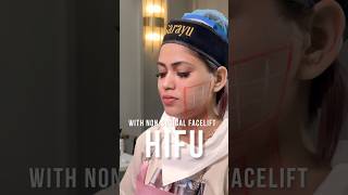 NonSurgical Facelift with HIFU by Dr Adarsh Tripathi  Sarayu Clinics hifu beauty [upl. by Ahasuerus]