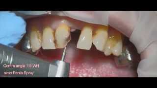 Anterior esthetic crown Distribué par DentalPAG [upl. by Enilkcaj]