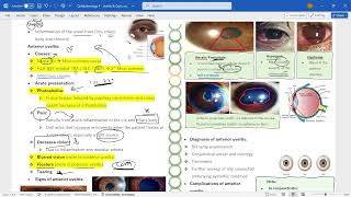 Ophthalmology 4  Uveitis amp optic neuritis [upl. by Maher]