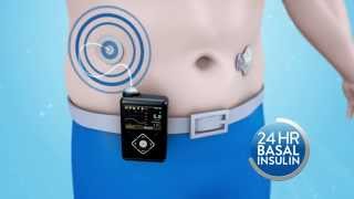 Medtronic MiniMed  How does the MiniMed 640G insulin pump work [upl. by Maxma]