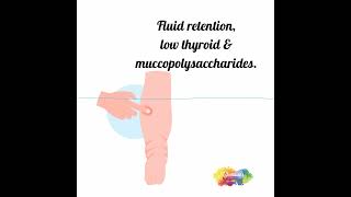 Fluid retention  edema  low thyroid [upl. by Assirolc]