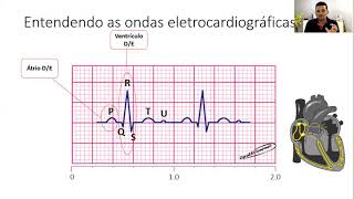 Fibrilação Atrial Como no Eletrocardiograma identificar a Fibrilação de Alta Resposta Ventricular [upl. by Nnylf]