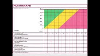 Partograph Exercise [upl. by Otilopih]