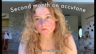 Accutane Journey  month 2 [upl. by Aeniah]