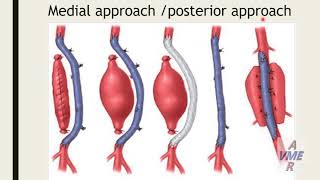 Popliteal artery aneurysm [upl. by Brower]