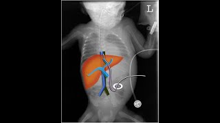 Xray amp US of Umbilical Venous Catheter Part1 [upl. by Lehcnom]