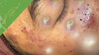 Blackhead removal and Acne Treatment for Huynh Luu Dai Thang Come back from Massachusetts [upl. by Ailenroc]