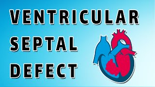 Ventricular Septal Defect [upl. by Herring599]