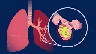 Understanding Pneumococcal Pneumonia [upl. by Caren]