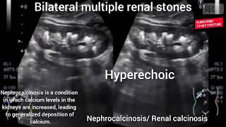 Renal calcinosis I Nephrocalcinosis I Renal calculi I Renal stones I Calcium depositions in kidneys [upl. by Zoeller16]