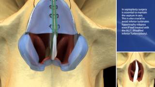 SEPTAL CARTILAGE FLAXATION GOTTARELLI 3GK KNOT [upl. by Iggie505]