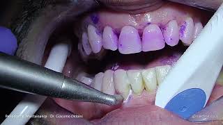 PROPHYLAXIS  Dr Giacomo Oldoini  Periodontal Mantainance [upl. by Hegarty]