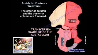 Kocher Langenbeck Approach for Acetabular Fractures  Michael Githens MD [upl. by Fechter]