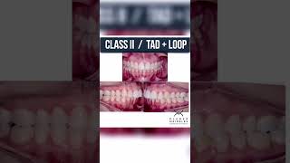 CLASS II  TAD  LOOP  ORTHODONTIC TIPS Shorts [upl. by Anitsirhcairam]