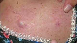 Back blackhead pimple popping [upl. by Odysseus]