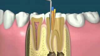 traitement endodontiquedevitalisationflv [upl. by Marciano348]