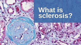 What is Sclerosis  Pathology mini tutorial [upl. by Gino267]